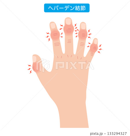 へバーデン結節 指の関節の病気 へバーデン結節 指の関節の病気 133294327