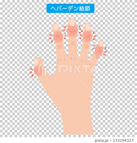 赫伯登結節:一種手指關節疾病 赫伯登結節:一種手指關節疾病 133294327