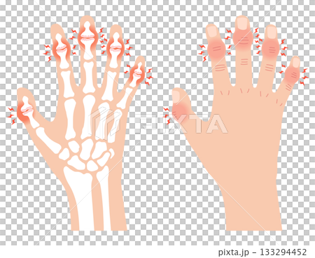 赫伯登結節:一種手指關節疾病 赫伯登結節:一種手指關節疾病 133294452