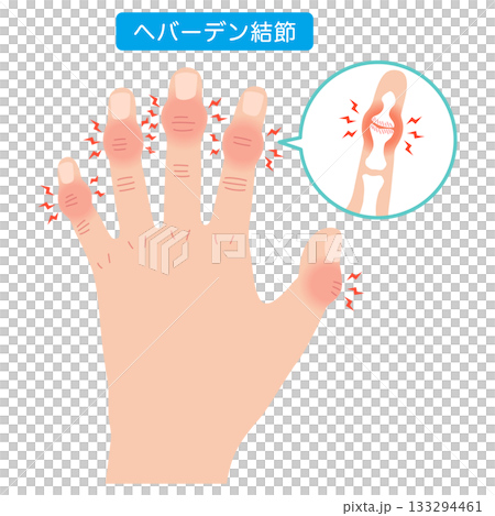 赫伯登結節:一種手指關節疾病 赫伯登結節:一種手指關節疾病 133294461