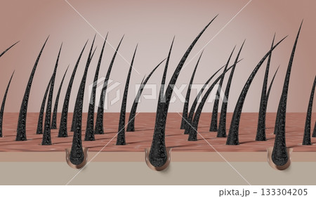 Dried and damaged hair follicles - 3D illustration 133304205
