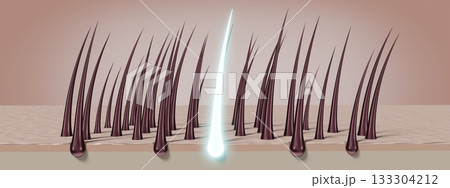 Hair follicles - regeneration concept - 3D illustration Hair follicles - regeneration concept - 3D illustration 133304212