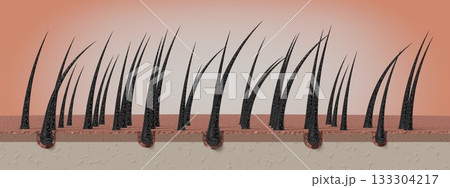 Dried and damaged hair follicles - 3D illustration Dried and damaged hair follicles - 3D illustration 133304217