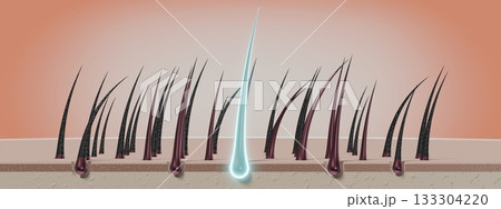 Hair follicles - regeneration concept - 3D illustration Hair follicles - regeneration concept - 3D illustration 133304220