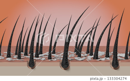 Hair follicles and dandruff under microscope - 3D illustration Hair follicles and dandruff under microscope - 3D illustration 133304274