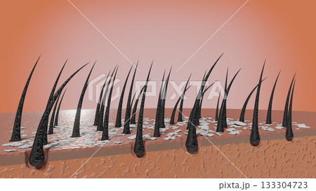 Hair follicles and dandruff under microscope - 3D illustration 133304723