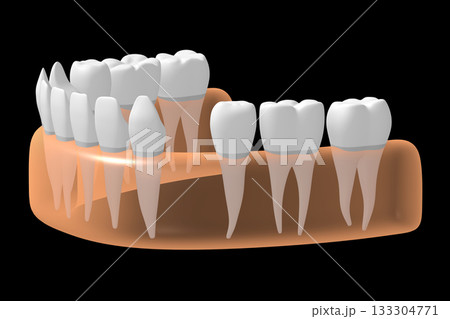 Gum with teeth and one missing - 3D illustration 133304771
