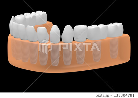 Dental teeth implats in gum - 3D illustration Dental teeth implats in gum - 3D illustration 133304791
