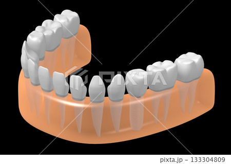 Tooth implant and healthy ones in gum - 3D illustration 133304809