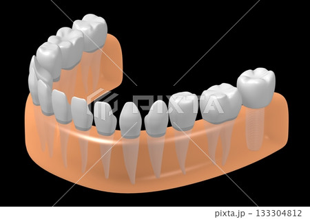 Tooth implant and healthy ones in gum - 3D illustration 133304812
