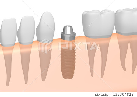 Tooth implant, other healthy teeth and gum - 3D illustration 133304828