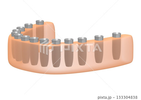 Dental teeth implats in gum - 3D illustration 133304838