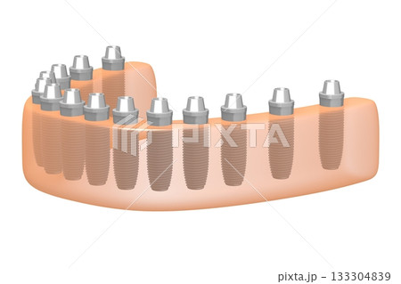 Dental teeth implats in gum - 3D illustration 133304839