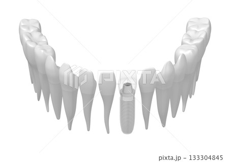 Health teeth and one implant isolated on white background - 3D illustration 133304845
