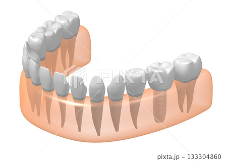 Tooth implant, other healthy ones and gum - 3D illustration Tooth implant, other healthy ones and gum - 3D illustration 133304860