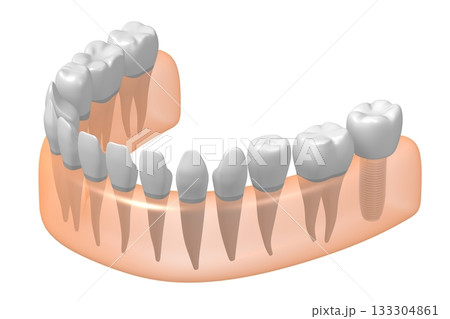 Tooth implant, other healthy ones and gum - 3D illustration 133304861