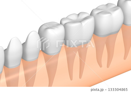 Tooth implant and healthy ones in gum - 3D illustration 133304865