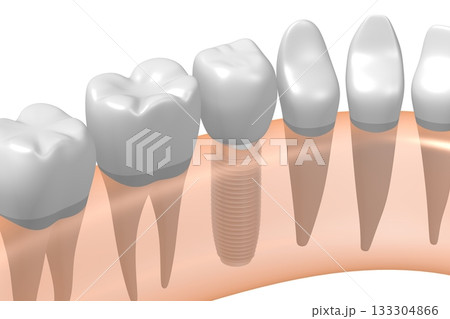Tooth implant, other healthy ones and gum - 3D illustration Tooth implant, other healthy ones and gum - 3D illustration 133304866