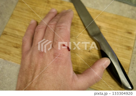 Kitchen knife accident minor cut 133304920