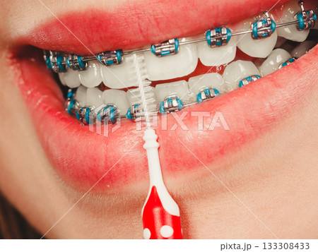 Woman smiling cleaning teeth with braces Woman smiling cleaning teeth with braces 133308433