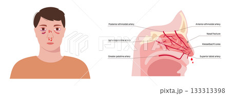 Nasal fracture poster Nasal fracture poster 133313398