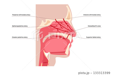 Nosebleed medical poster 133313399