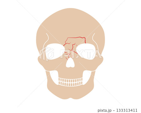 Nasal fracture poster 133313411