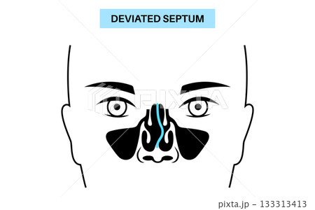 Deviated septum poster Deviated septum poster 133313413