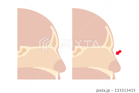 Nasal fracture poster Nasal fracture poster 133313415