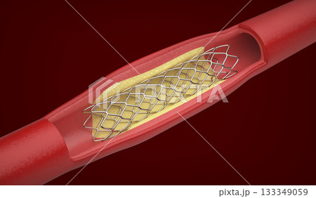 Medical stent inside blood vessel Medical stent inside blood vessel 133349059