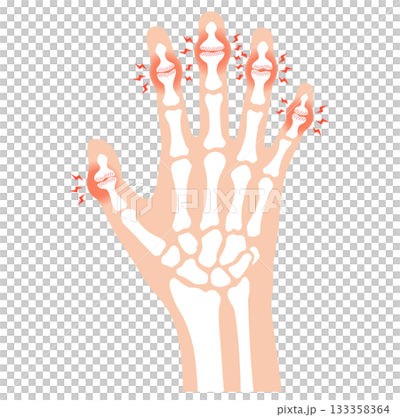 Heberden's nodes: a disease of the finger joints 133358364