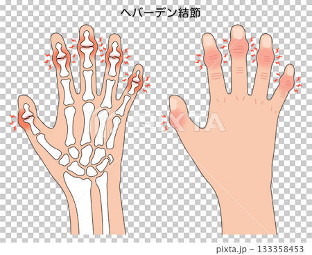 Heberden's nodes: a disease of the finger joints Heberden's nodes: a disease of the finger joints 133358453