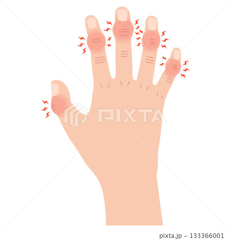 へバーデン結節　指の関節の病気 133366001