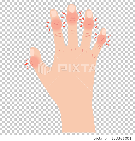 へバーデン結節　指の関節の病気 133366001