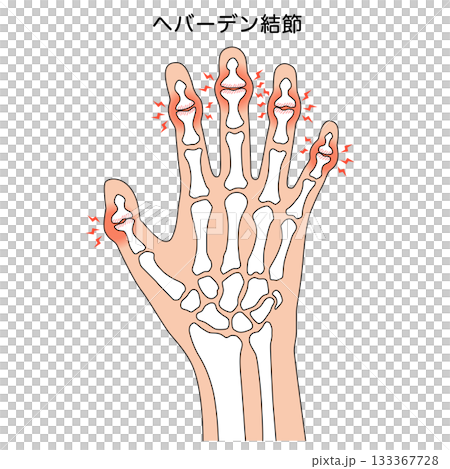 Heberden's nodes: a disease of the finger joints 133367728
