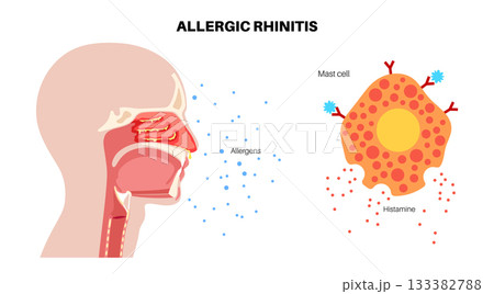 Allergic rhinitis poster 133382788