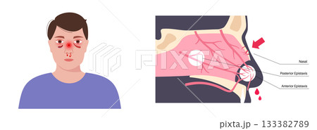 Nasal fracture poster 133382789
