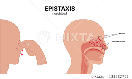 Stop nosebleed instruction Stop nosebleed instruction 133382791