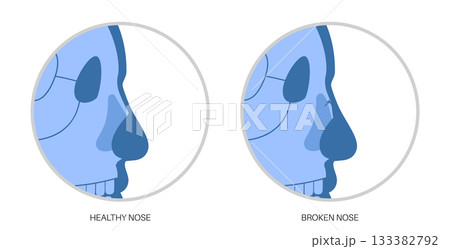 Nasal fracture poster Nasal fracture poster 133382792
