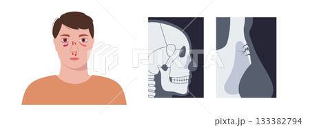 Nasal fracture poster Nasal fracture poster 133382794