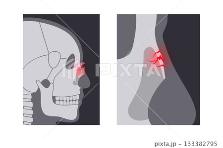 Nasal fracture poster 133382795