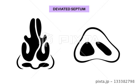 Deviated septum poster Deviated septum poster 133382798