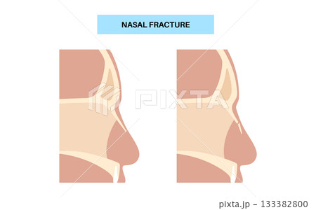 Nasal fracture poster 133382800