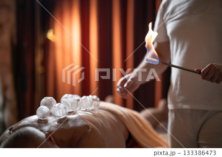 Close up of a traditional fire cupping therapy session with glass cups placed on a patients back and therapist using fire to create suction, promoting relaxation and healing. 133386473