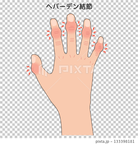 Heberden's nodes: a disease of the finger joints 133398181