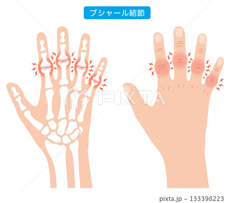 ブシャール結節　指の関節の病気 133398223