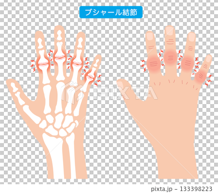 Bouchard's nodes: a disease of the finger joints 133398223