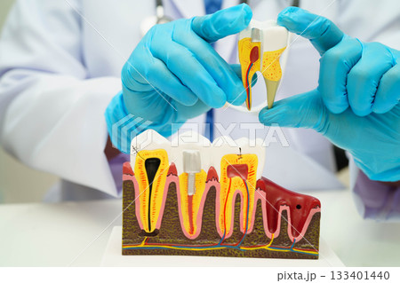 Dentist holding dental implant, artificial tooth roots into jaw, root canal of dental treatment, gum disease, teeth model for dentist. Dentist holding dental implant, artificial tooth roots into jaw, root canal of dental treatment, gum disease, teeth model for dentist. 133401440