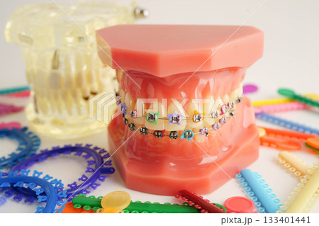 Orthodontic ligatures rings and ties, elastic rubber bands on orthodontic braces, model for dentist studying about dentistry. Orthodontic ligatures rings and ties, elastic rubber bands on orthodontic braces, model for dentist studying about dentistry. 133401441