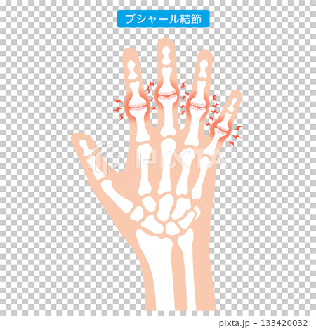 Bouchard's nodes: a disease of the finger joints 133420032